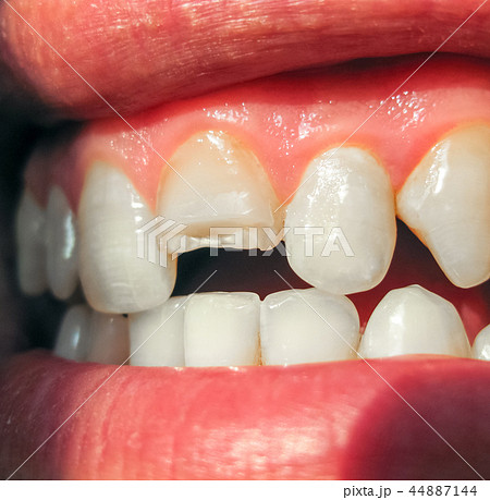 Broken tooth. Broken upper incisor in a man mouth. 44887144