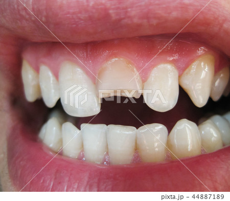 Broken tooth. Broken upper incisor in a man mouth. 44887189
