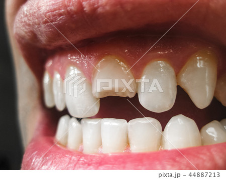 Broken tooth. Broken upper incisor in a man mouth. 44887213