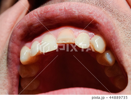 Broken tooth. Broken upper incisor in a man mouth. 44889735