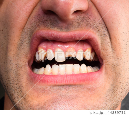 Broken tooth. Broken upper incisor in a man mouth. Broken tooth. Broken upper incisor in a man mouth. 44889751