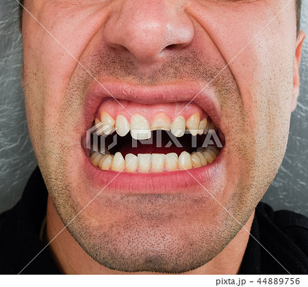Broken tooth. Broken upper incisor in a man mouth. 44889756