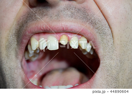 The process of replacing a tooth. Preparation of the tooth under the crown. Pin in the tooth. The process of replacing a tooth. Preparation of the tooth under the crown. Pin in the tooth. 44890604