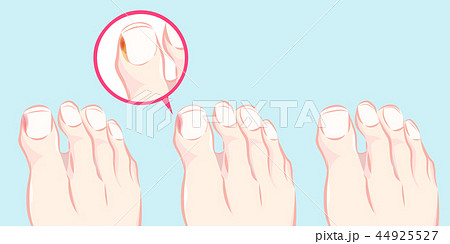 healthy foot and ingrown nail healthy foot and ingrown nail 44925527