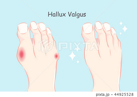 normal foot and hallux valgus normal foot and hallux valgus 44925528