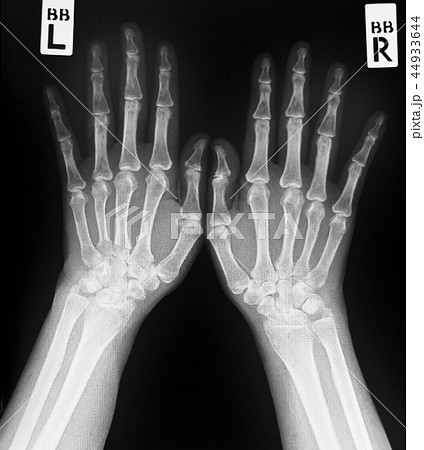 X-ray of both human hands.Normal human hands. X-ray of both human hands.Normal human hands. 44933644