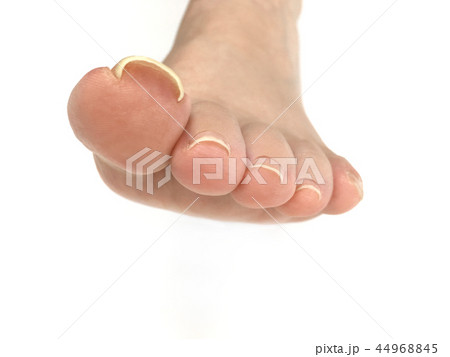 巻き爪 44968845