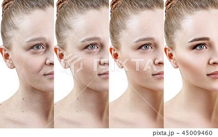 Woman with phase of skin rejuvenation before and after treatment. 45009460