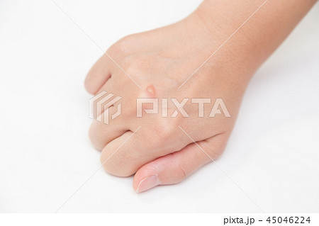 水ぶくれ 45046224