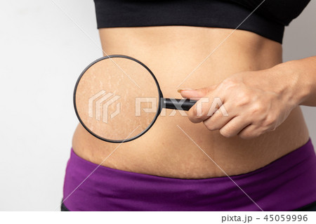 Women Show off the belly after birth. Stretch Mark 45059996