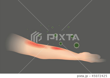Skin allergy. The appearance of rash in the arm. Skin allergy. The appearance of rash in the arm. 45072425