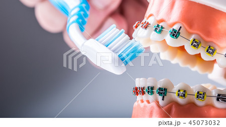 Close-up teeth braces and tooth brush. Close-up teeth braces and tooth brush. 45073032