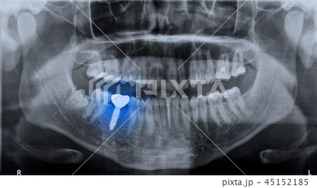 Roentgen teeth upper and lower jaw 45152185