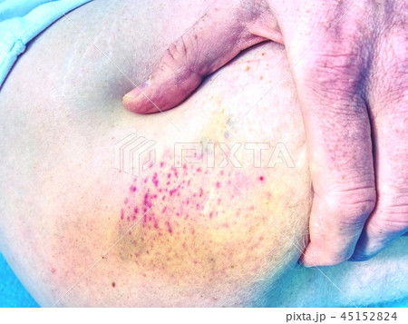 Fresh bruise. Painful purple huge bruise on leg. Fresh bruise. Painful purple huge bruise on leg. 45152824