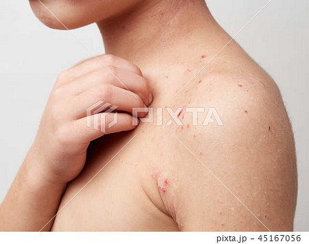 子どものアトピー・乾燥肌・皮膚炎イメージ 45167056