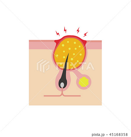 皮膚断面図 ニキビの進行　イラスト / 黄ニキビ（膿ニキビ） 45168358