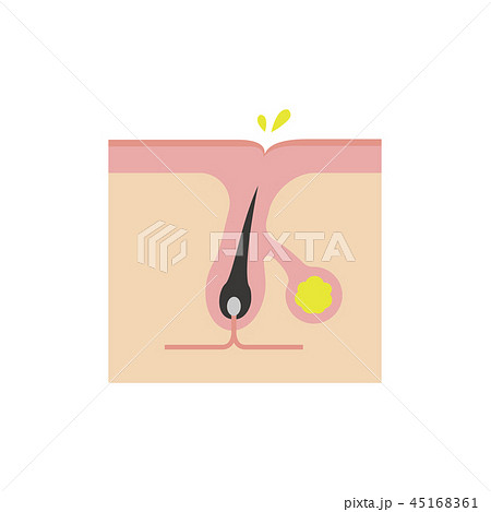 皮膚断面図 ニキビの進行　イラスト / 皮脂の過剰分泌 45168361