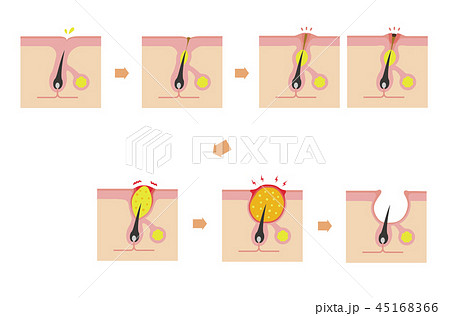 おもなニキビの種類と症状の進行 イラスト(文字なし) おもなニキビの種類と症状の進行 イラスト(文字なし) 45168366