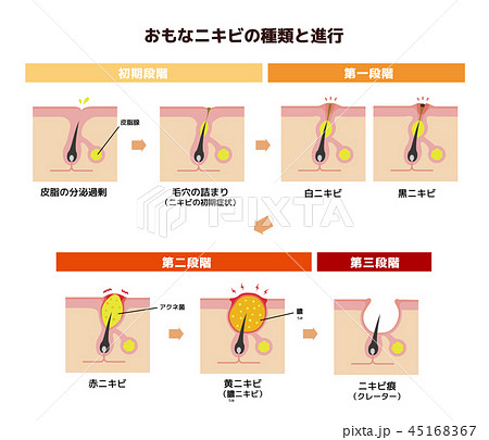 おもなニキビの種類と症状の進行　イラスト(日本語) 45168367