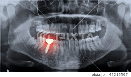 Roentgen teeth upper and lower jaw 45216597