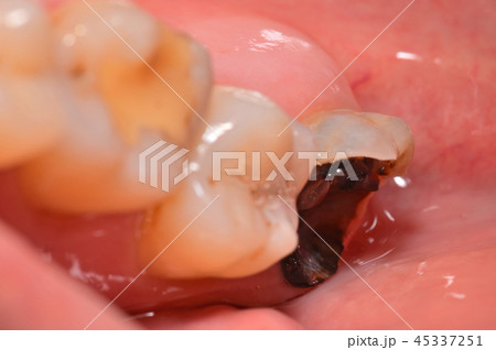虫歯 45337251