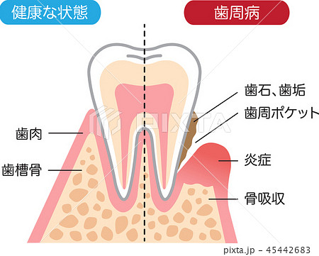 歯周病と健康な歯 断面図のイラスト素材