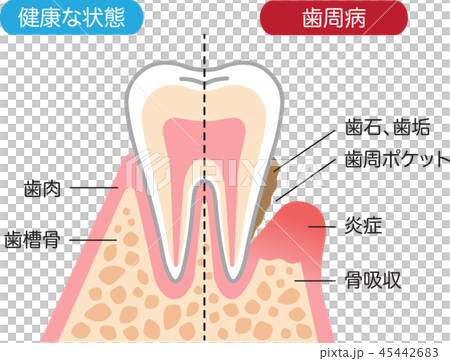 歯周病と健康な歯　断面図 45442683