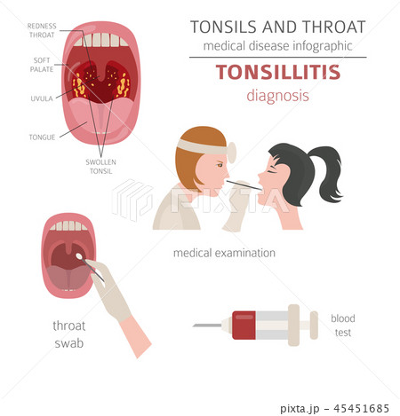 Tonsils and throat diseases. Tonsillitis Tonsils and throat diseases. Tonsillitis 45451685