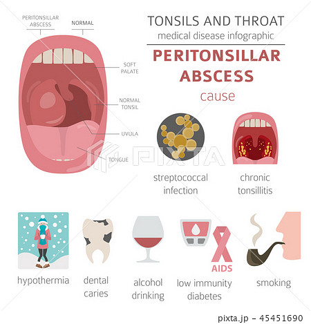 Tonsils and throat diseases. Peritonsillar abscess 45451690