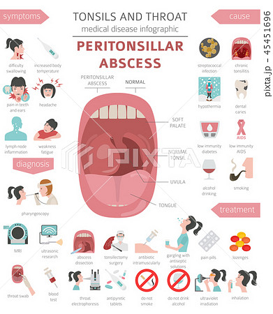 Tonsils and throat diseases. Peritonsillar abscess 45451696