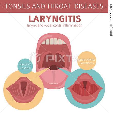 Tonsils and throat diseases. Laryngitis Tonsils and throat diseases. Laryngitis 45451704
