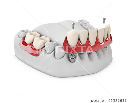 teeth and dental implant in jaw bone 45521631