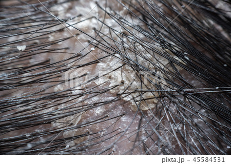 Hair scalp with dandruff and scaly from psoriasis 45584531