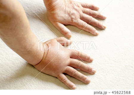 蜂に刺されて 腫れ上がった男性の手 45622568