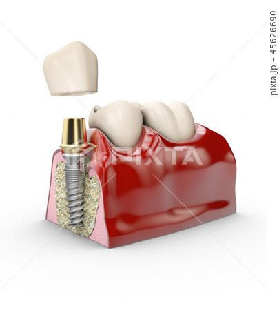 jaw model tooth implant 45626690