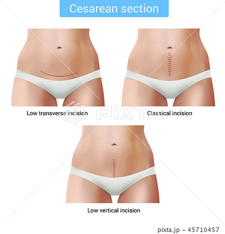 Cesarean Section Stitches Composition Cesarean Section Stitches Composition 45710457