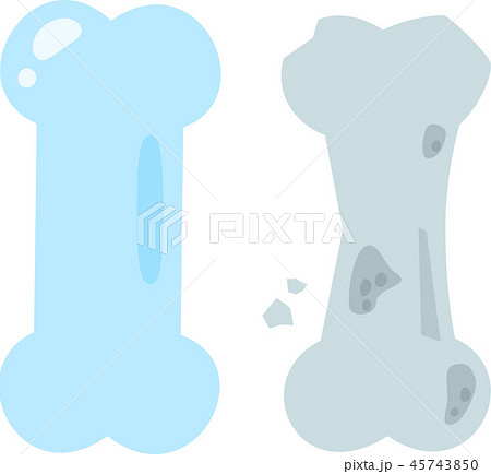 脆い骨と健康な骨、骨粗鬆症 45743850