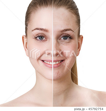 Young woman before and after treatment and make-up. Young woman before and after treatment and make-up. 45792754
