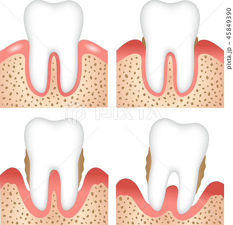 歯周病の進行 45849390