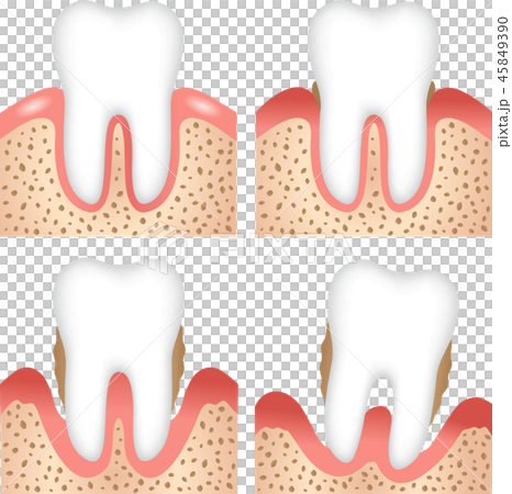 歯周病の進行 45849390