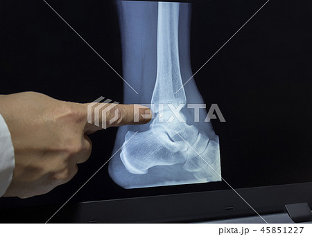 An xray of a heel with a doctors hand 45851227