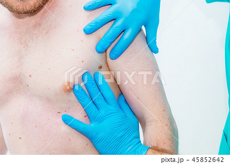 Doctor dermatologist examines birthmark of patient 45852642