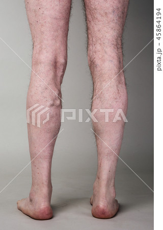 Tight varicose vein on a mans legs Tight varicose vein on a mans legs 45864194
