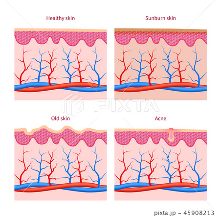 Skin types healthy, sunburn and old acne vector set Skin types healthy, sunburn and old acne vector set 45908213