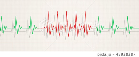sudden arrhythmia illustration 45928287