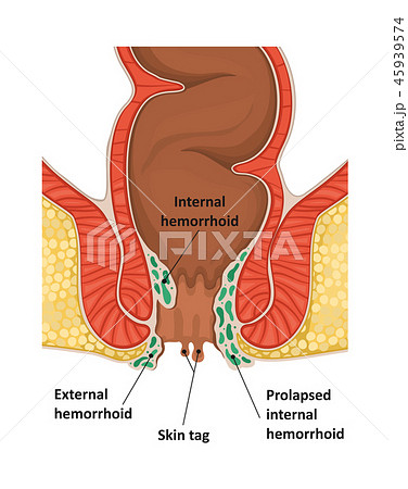 Types of hemorrhoids. 45939574