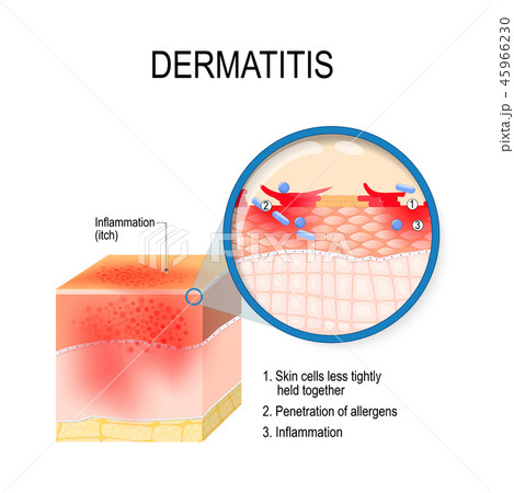 Atopic dermatitis (atopic eczema) 45966230