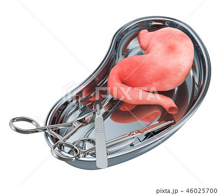 Stomach transplant surgery concept. Donor stomach 46025700