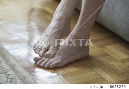 damaged nails because of fungus and athlete's foot 46073279