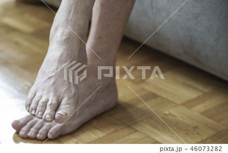 damaged nails because of fungus and athlete's foot damaged nails because of fungus and athlete's foot 46073282